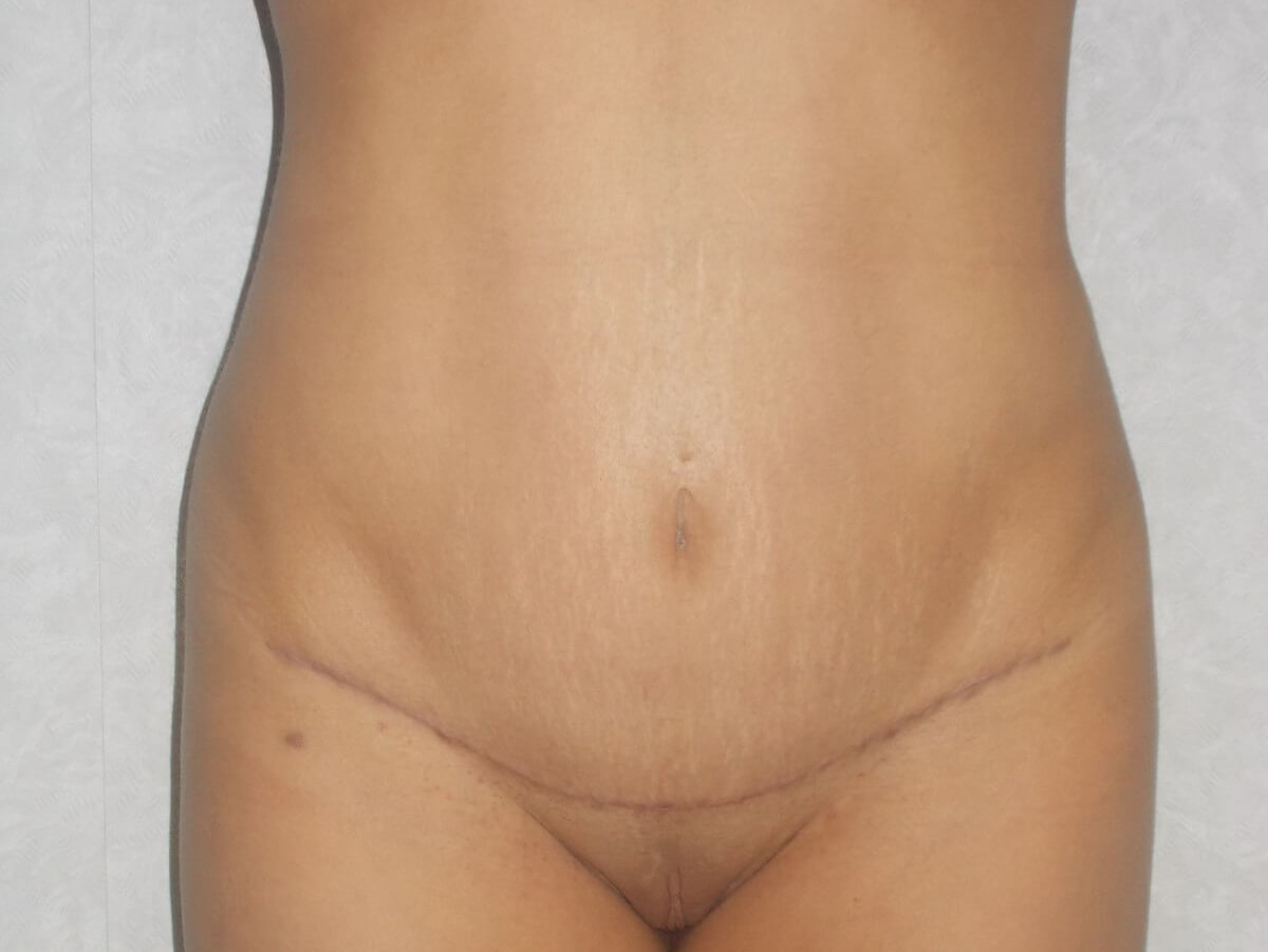 Front View After