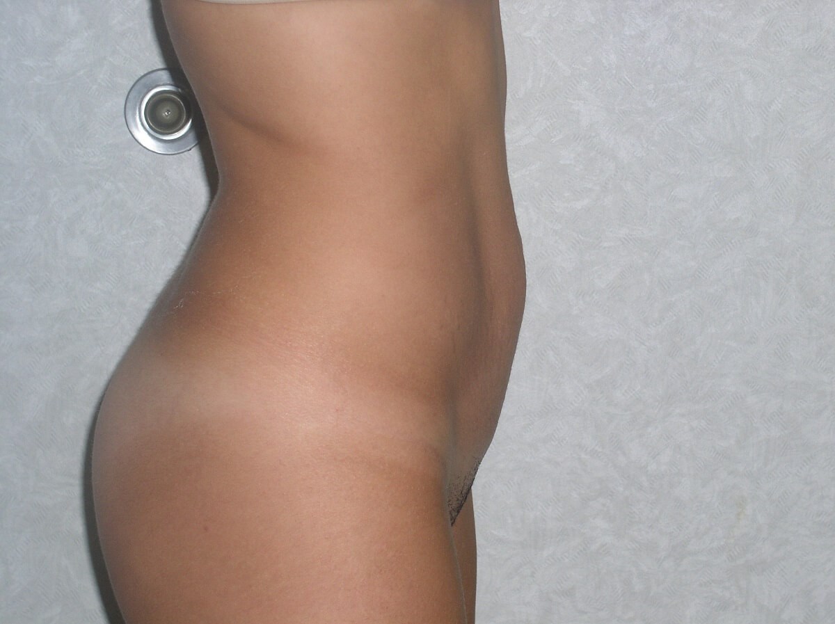 Side View Before