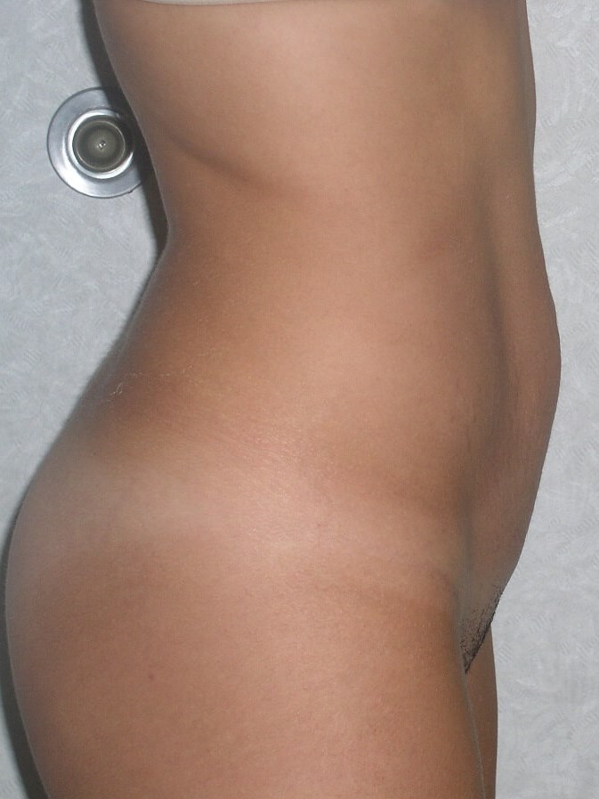 Side View Before