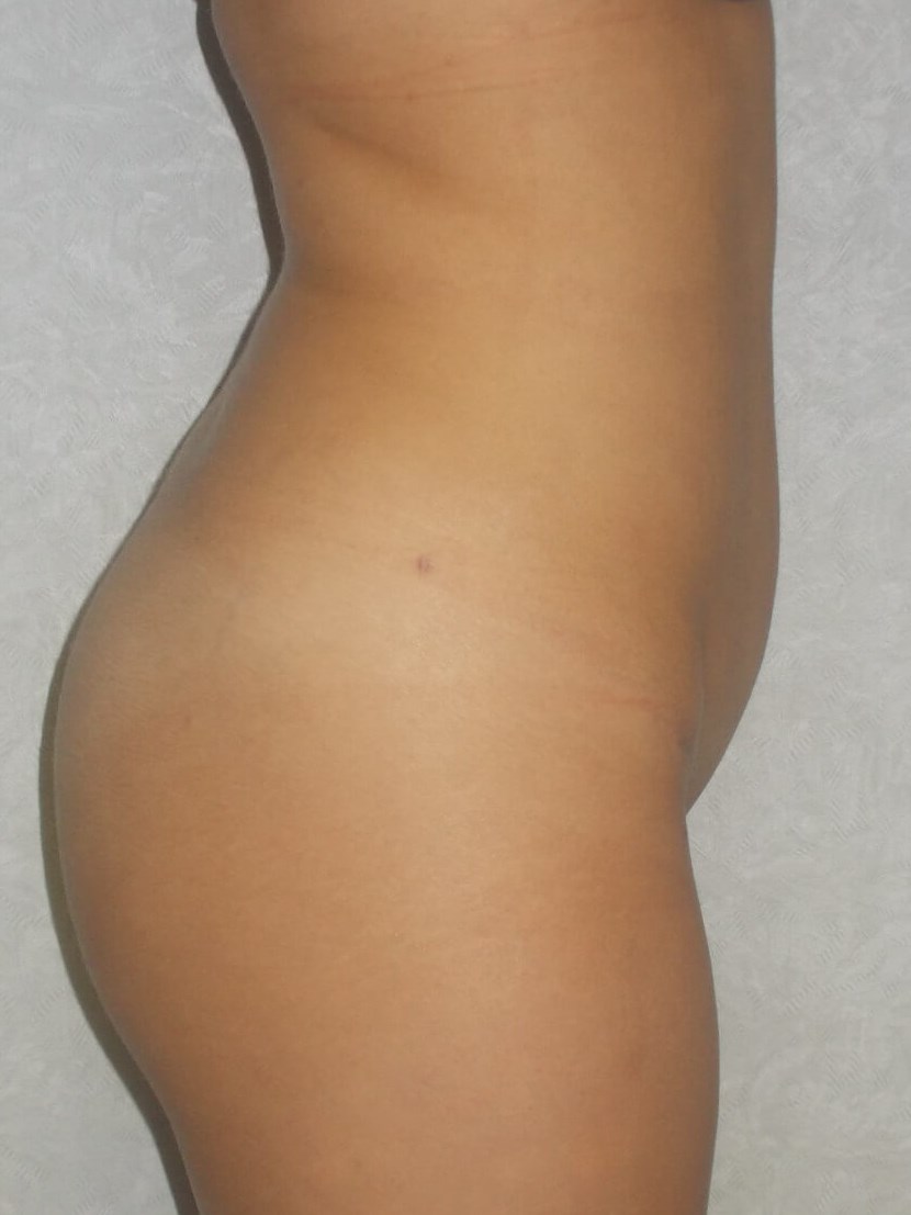 Side View After