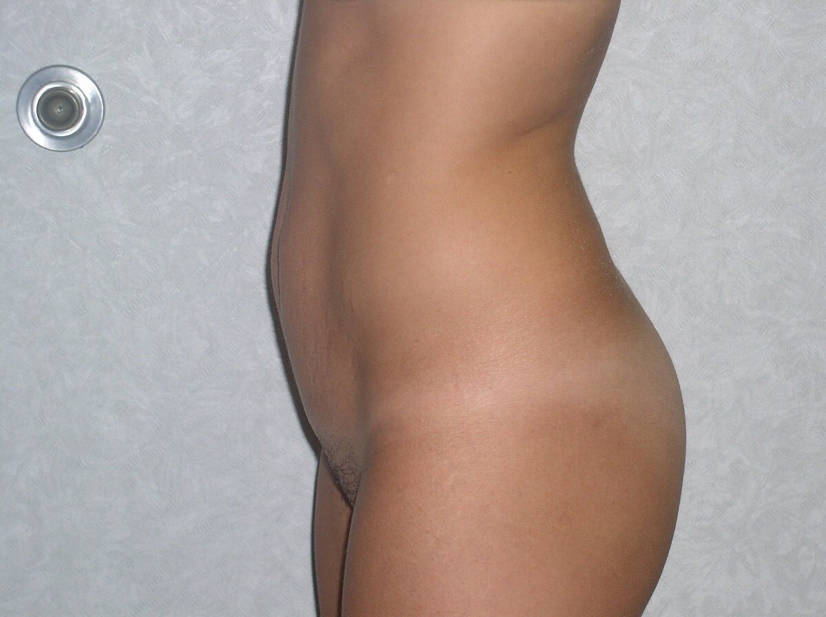 Side View Before