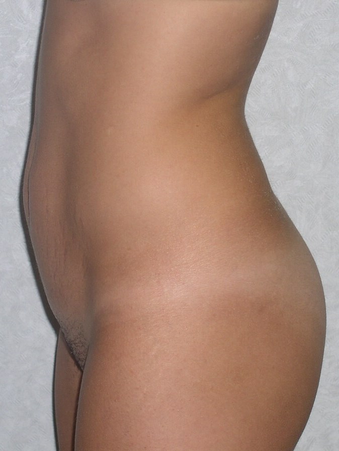 Side View Before