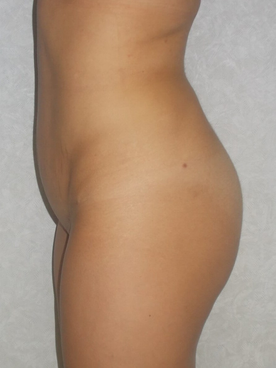 Side View After