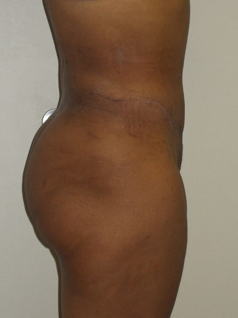 Side View After