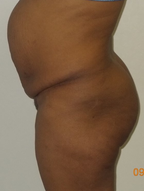 Side View Before