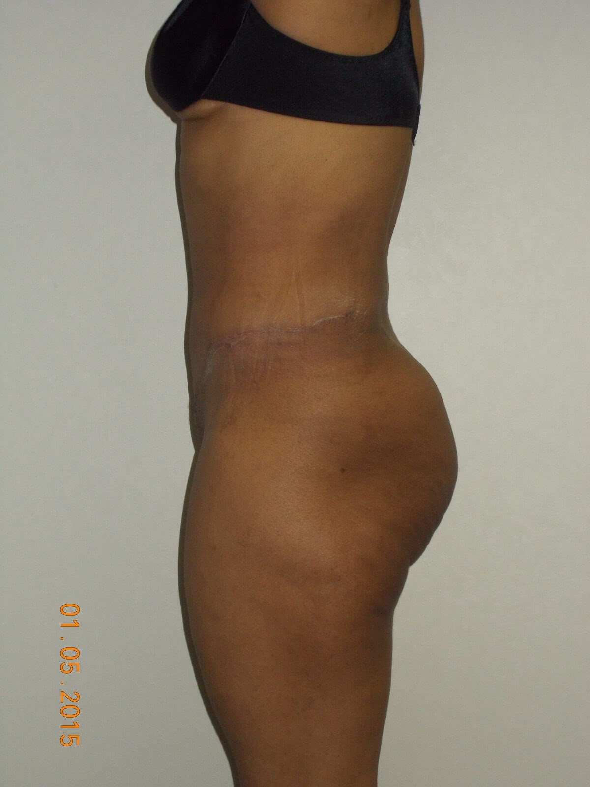 Side View After