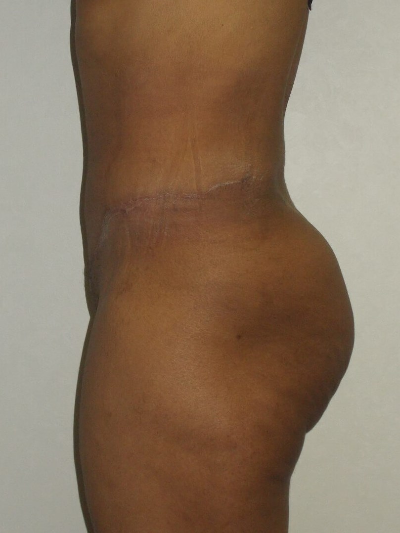 Side View After