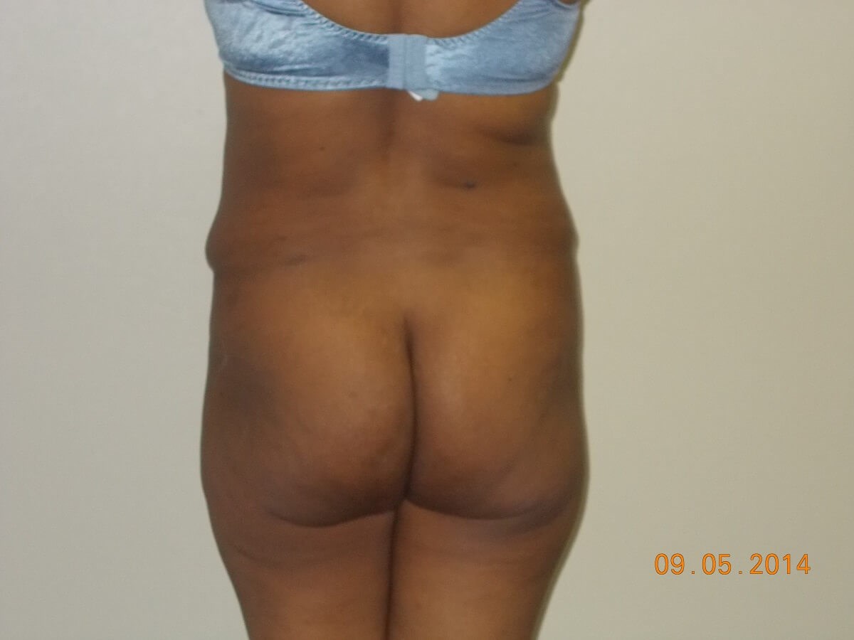 Back View Before