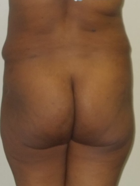 Back View Before