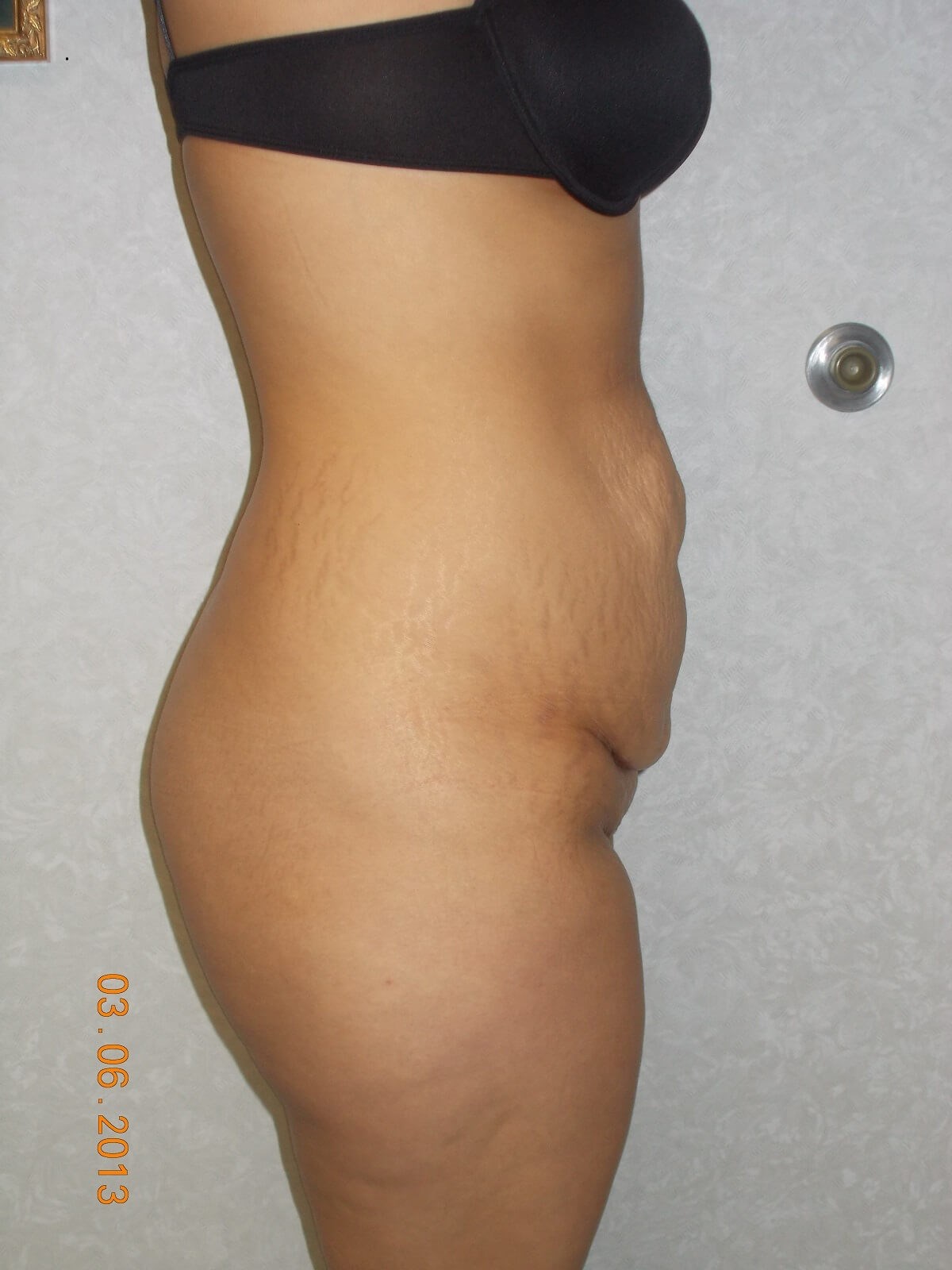 Side View Before
