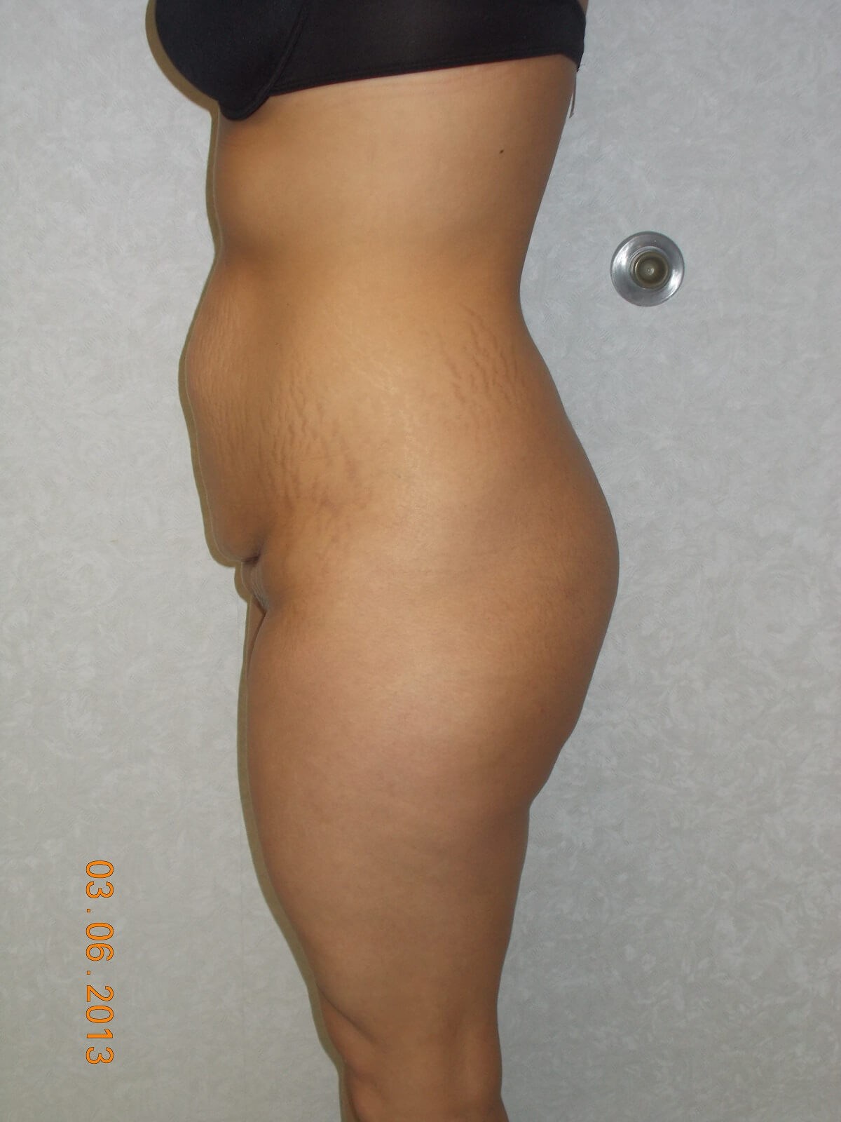 Side View Before