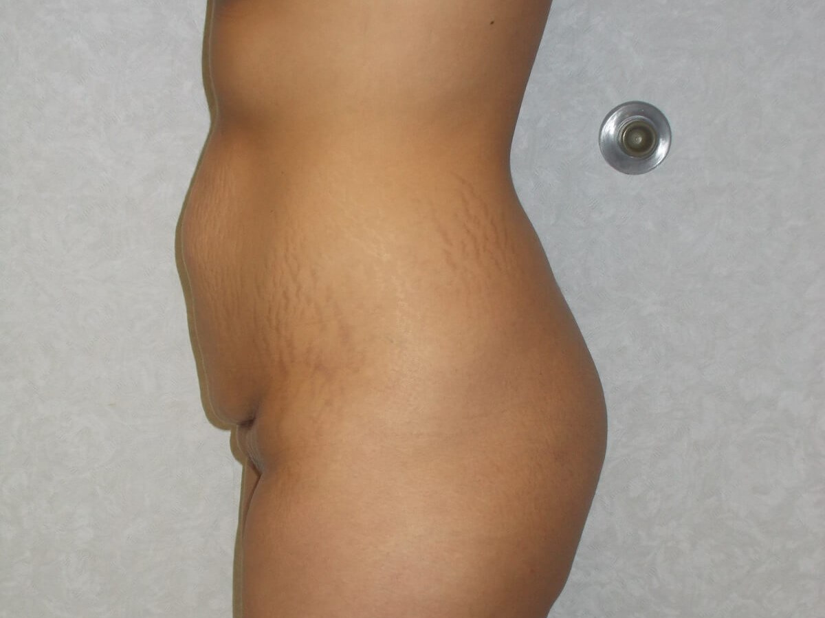 Side View Before
