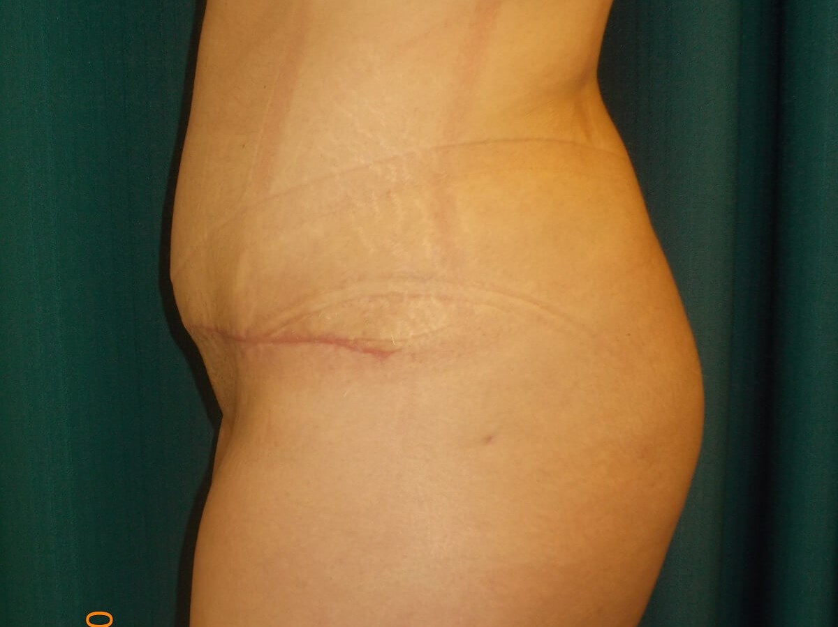 Side View After