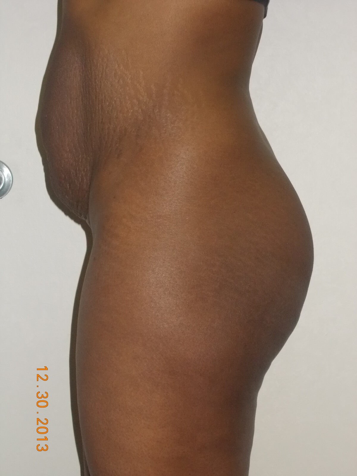 Side View Before