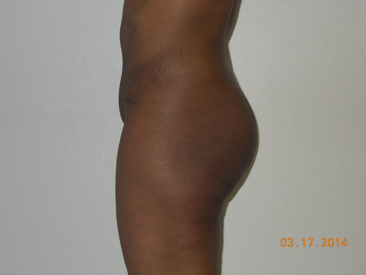 Side View After