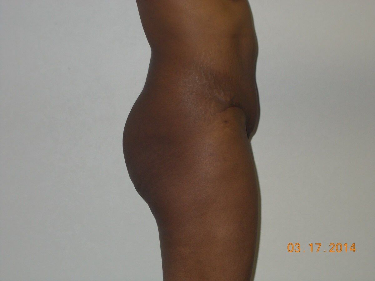 Side View After