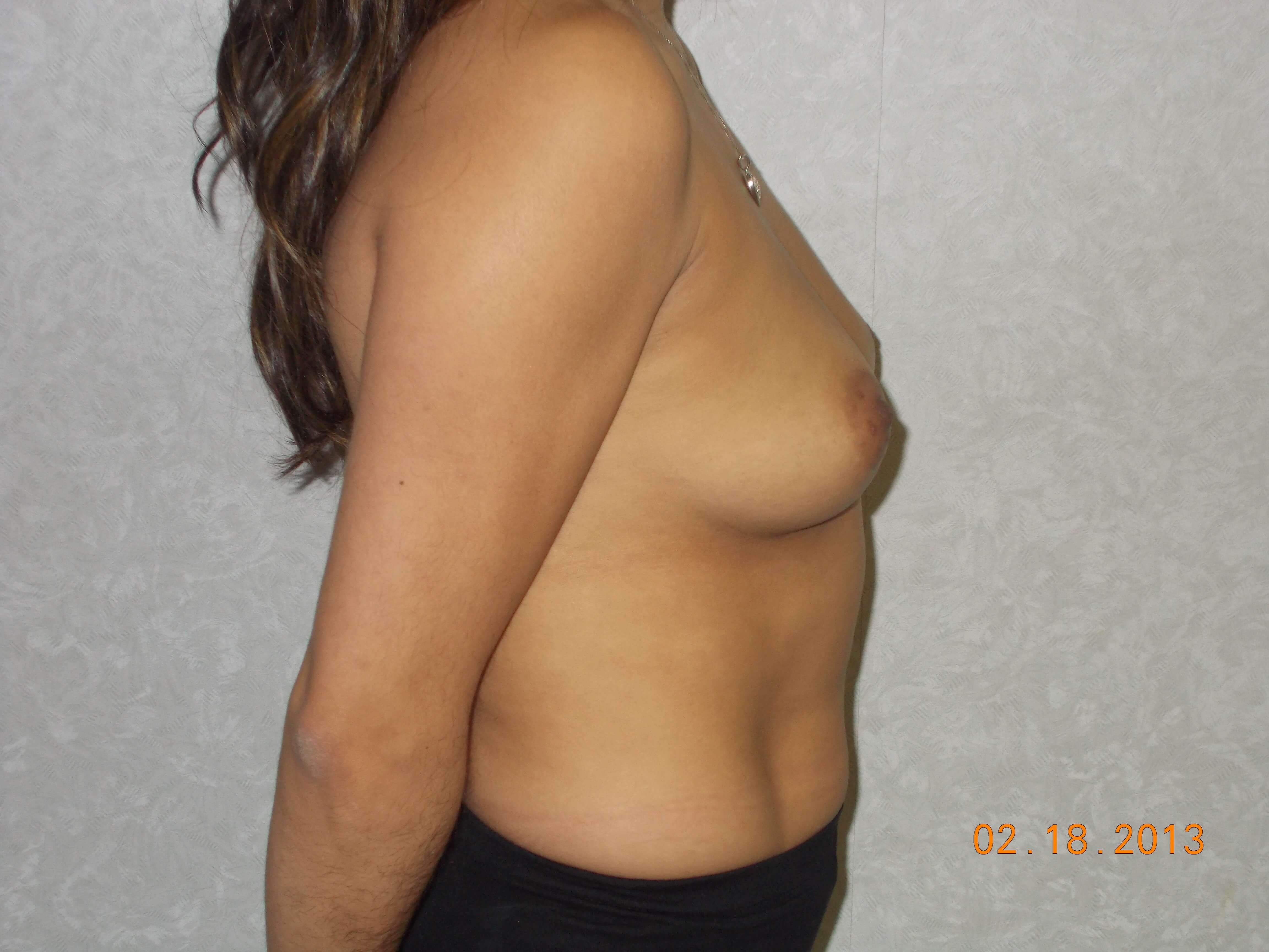 Side View Before