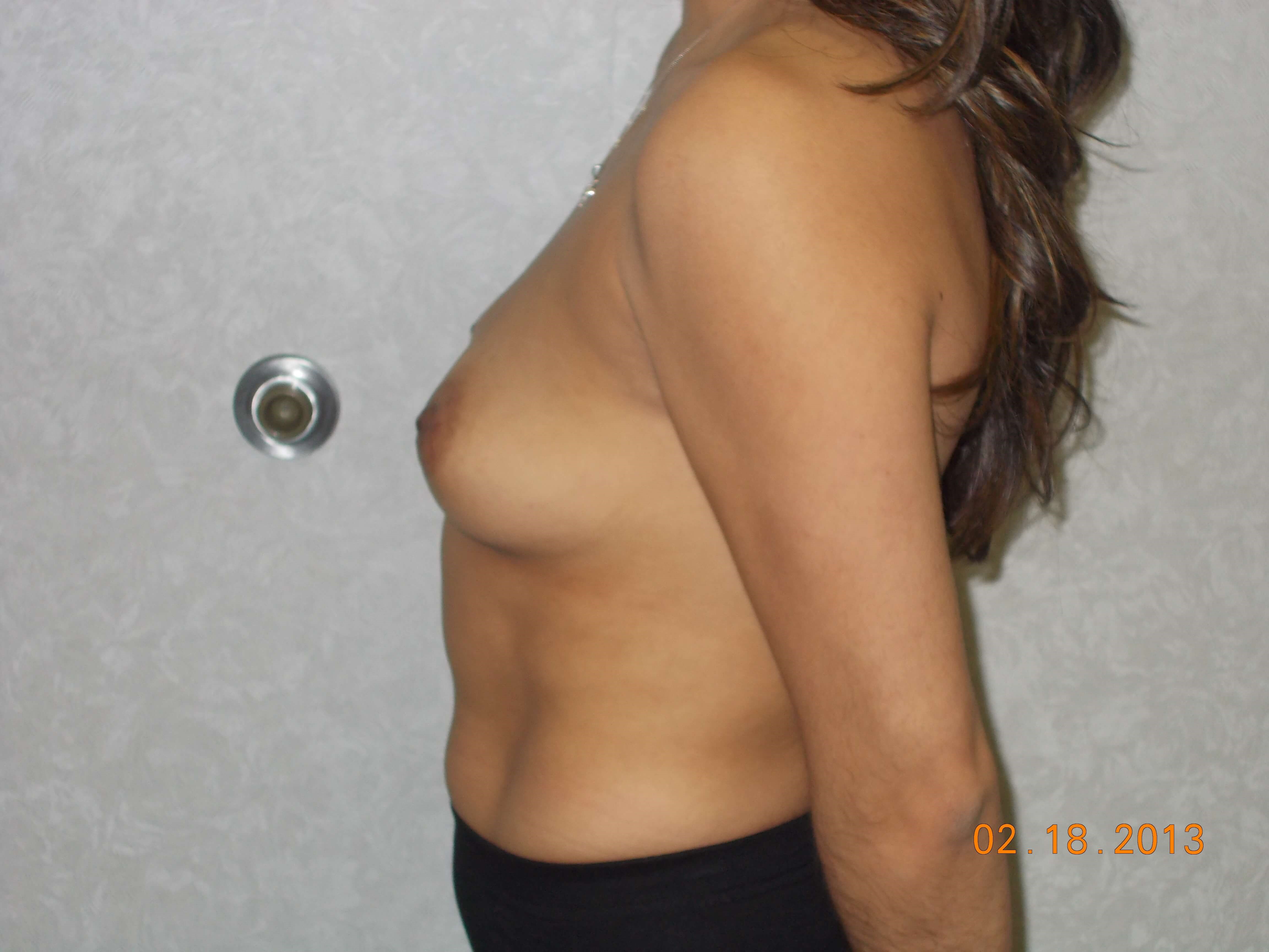 Side View Before