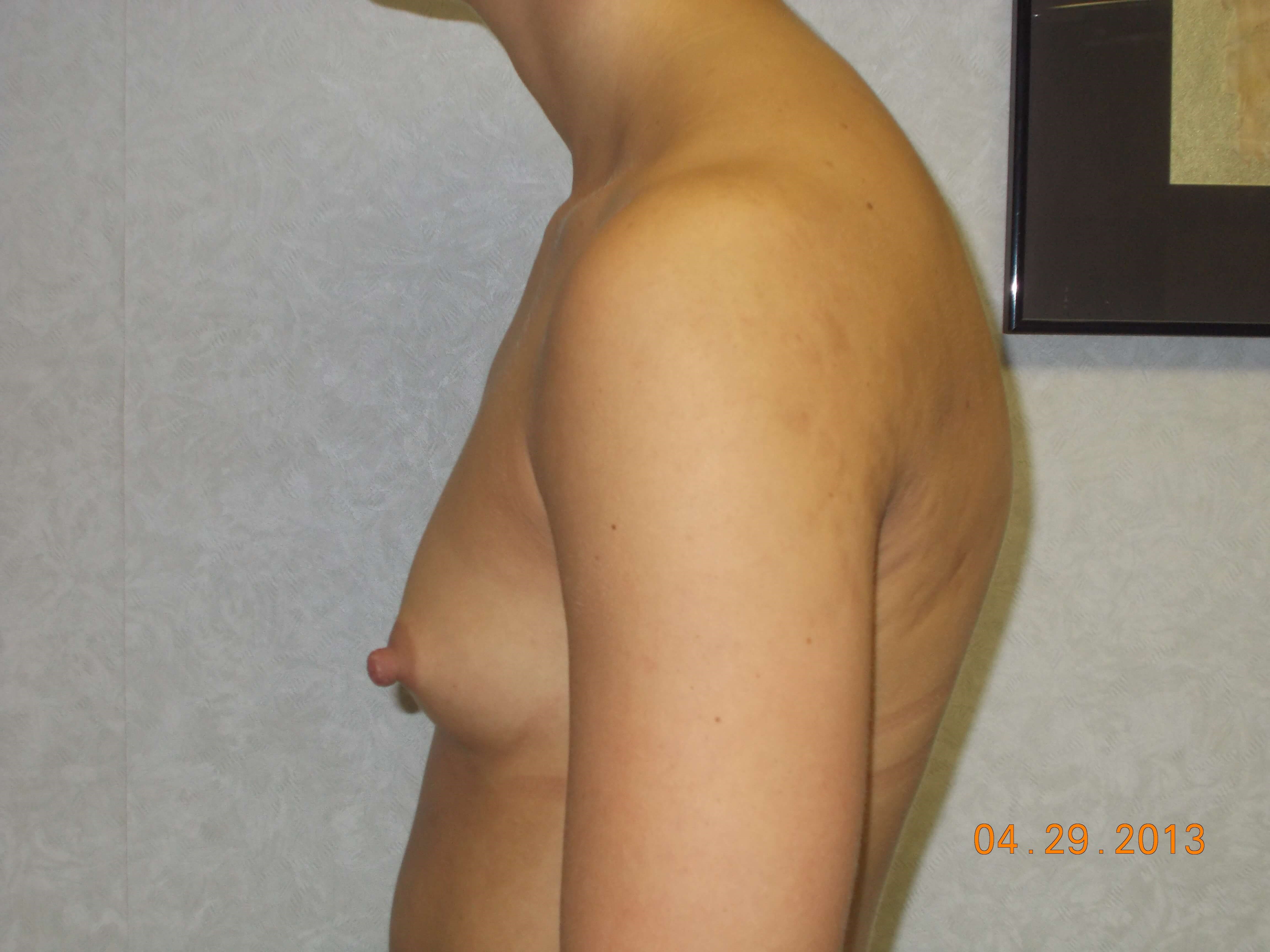 Side View Before