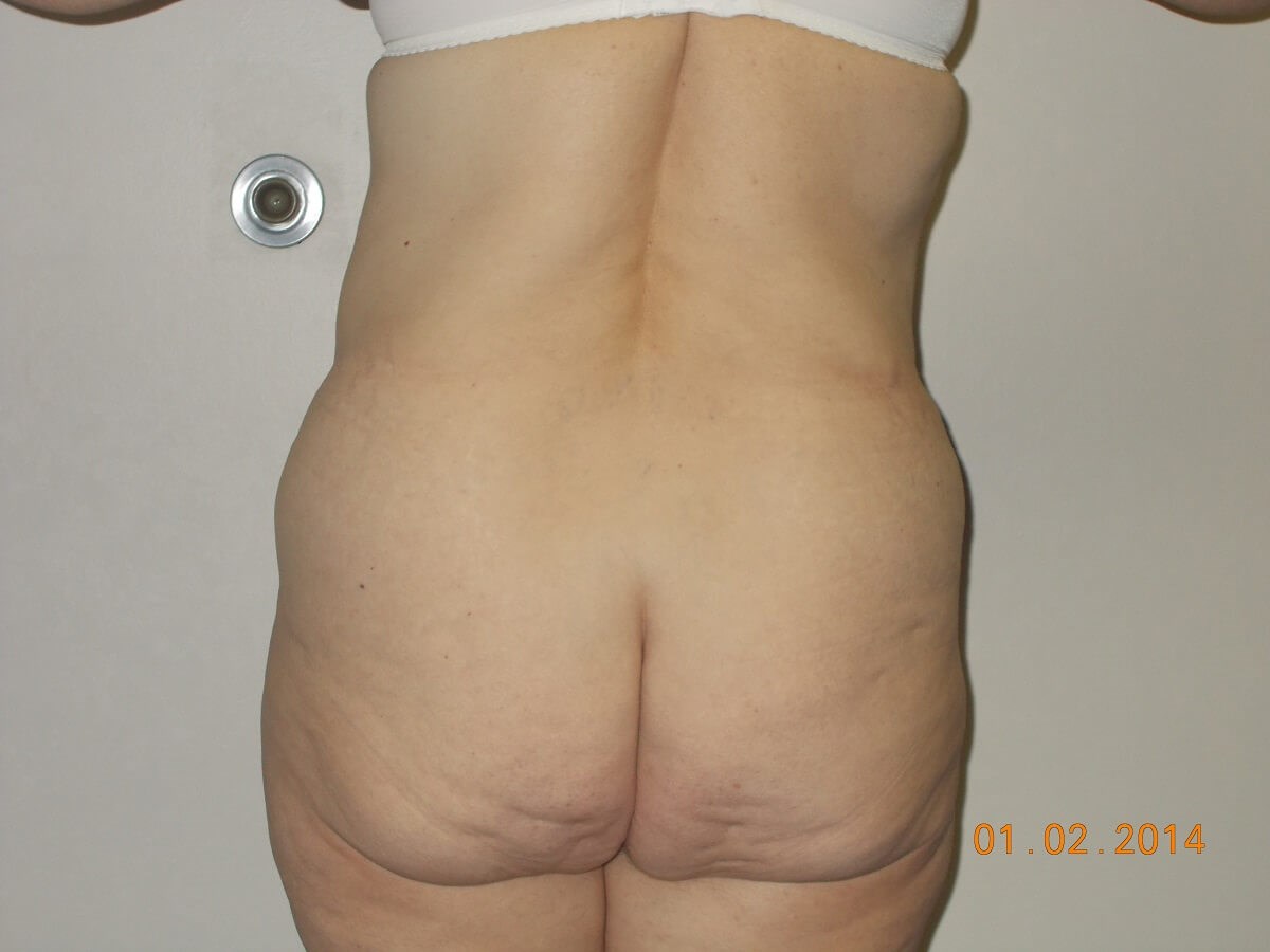Back View Before