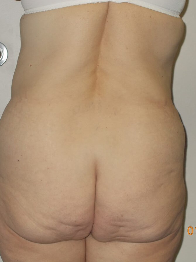 Back View Before