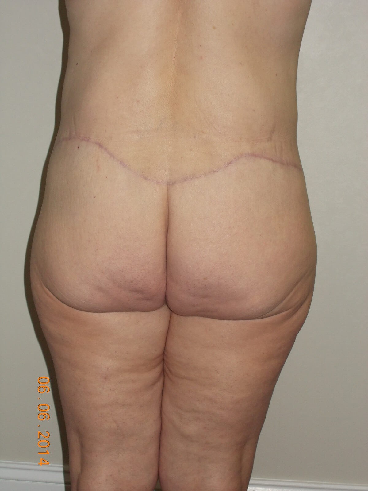 Back View After