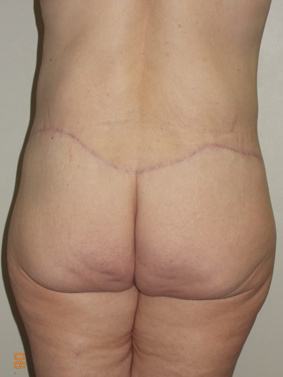 Back View After