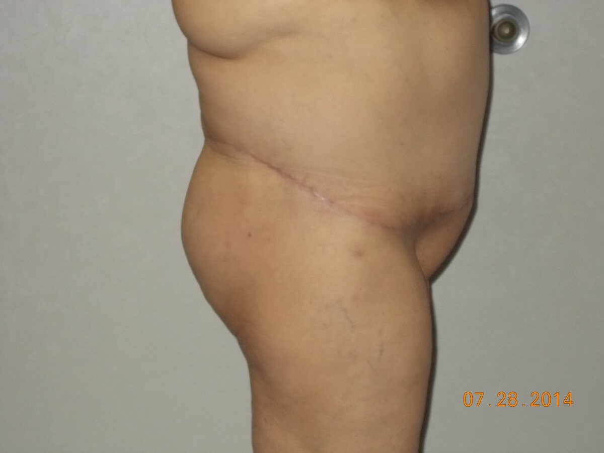 Side View After