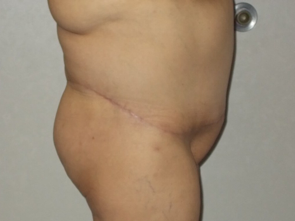 Side View After