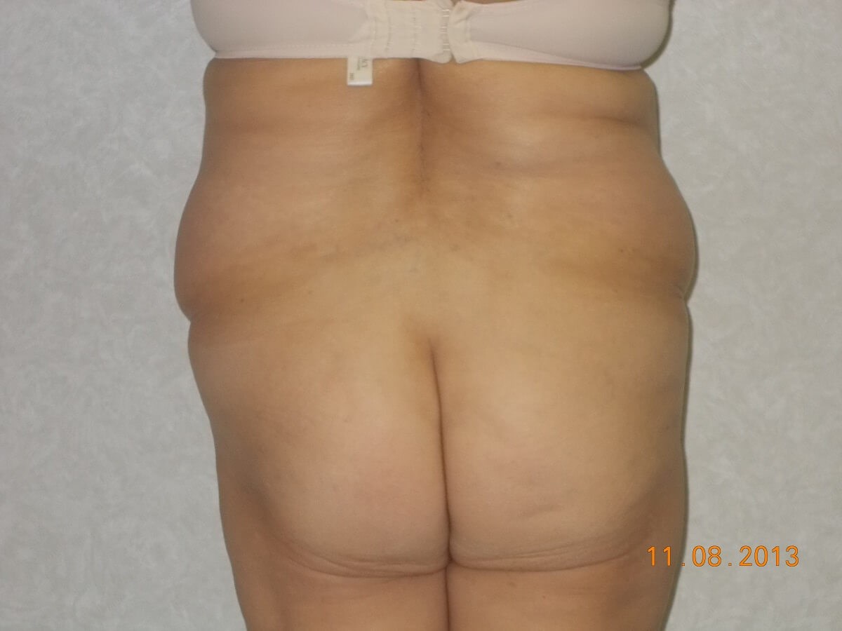Back View Before