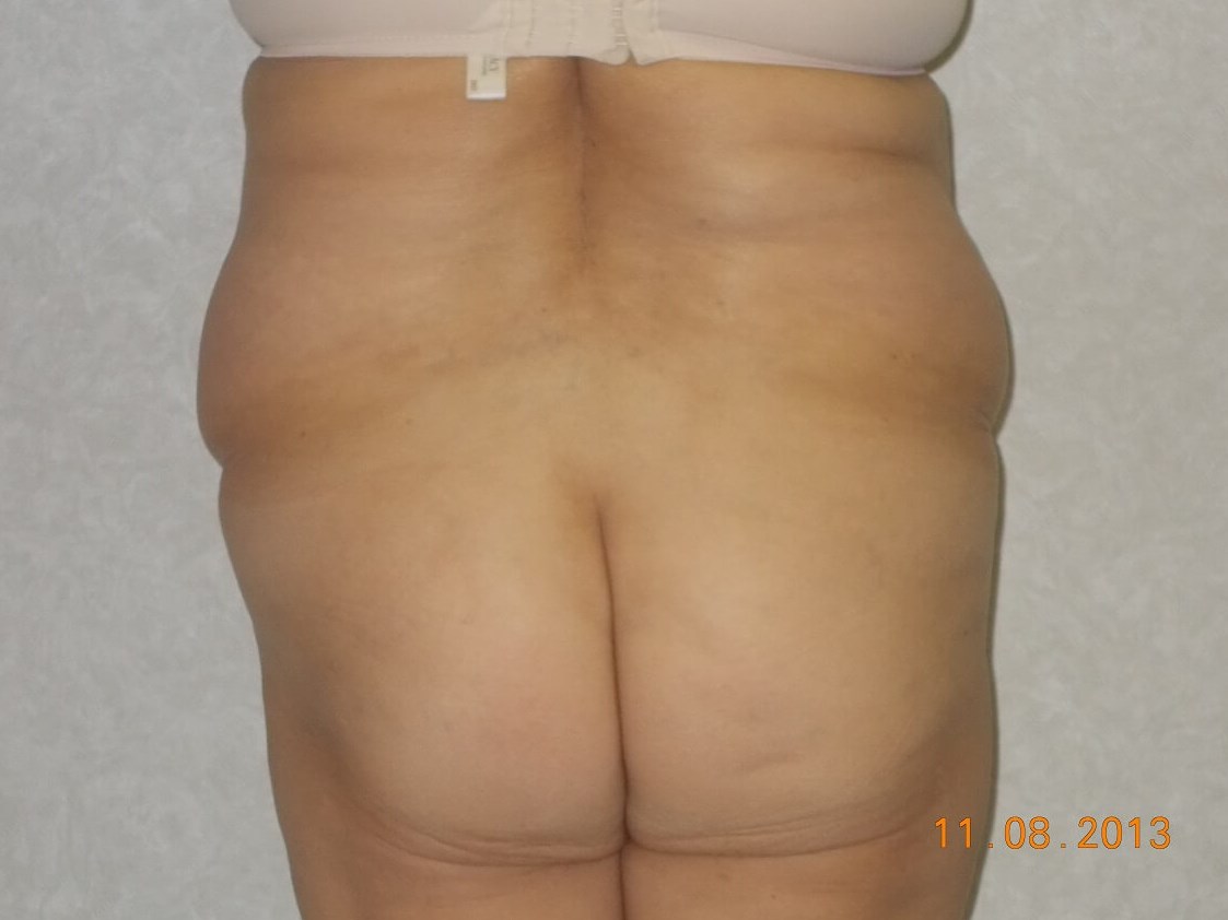 Back View Before