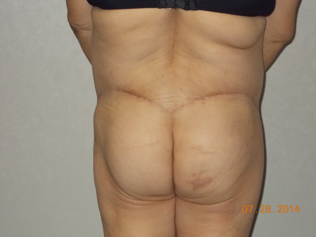 Back View After
