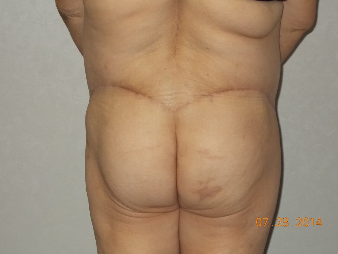 Back View After