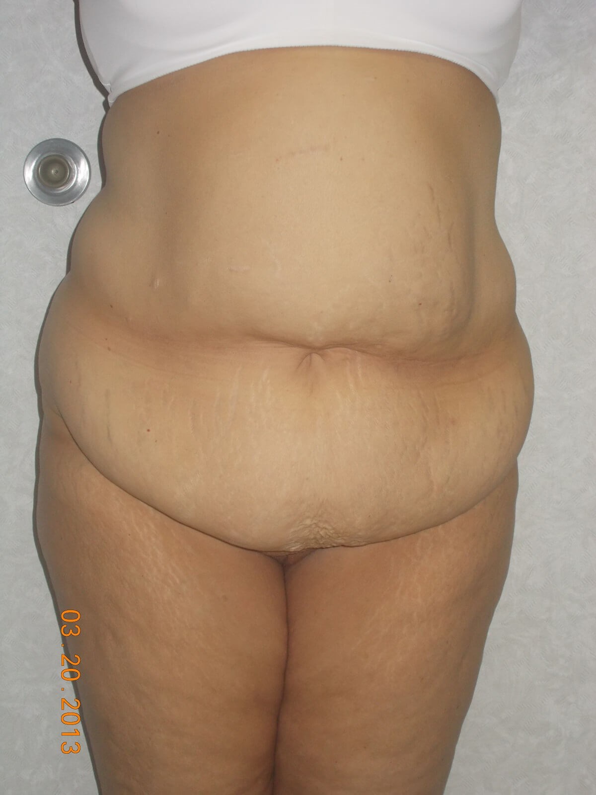 Front View Before