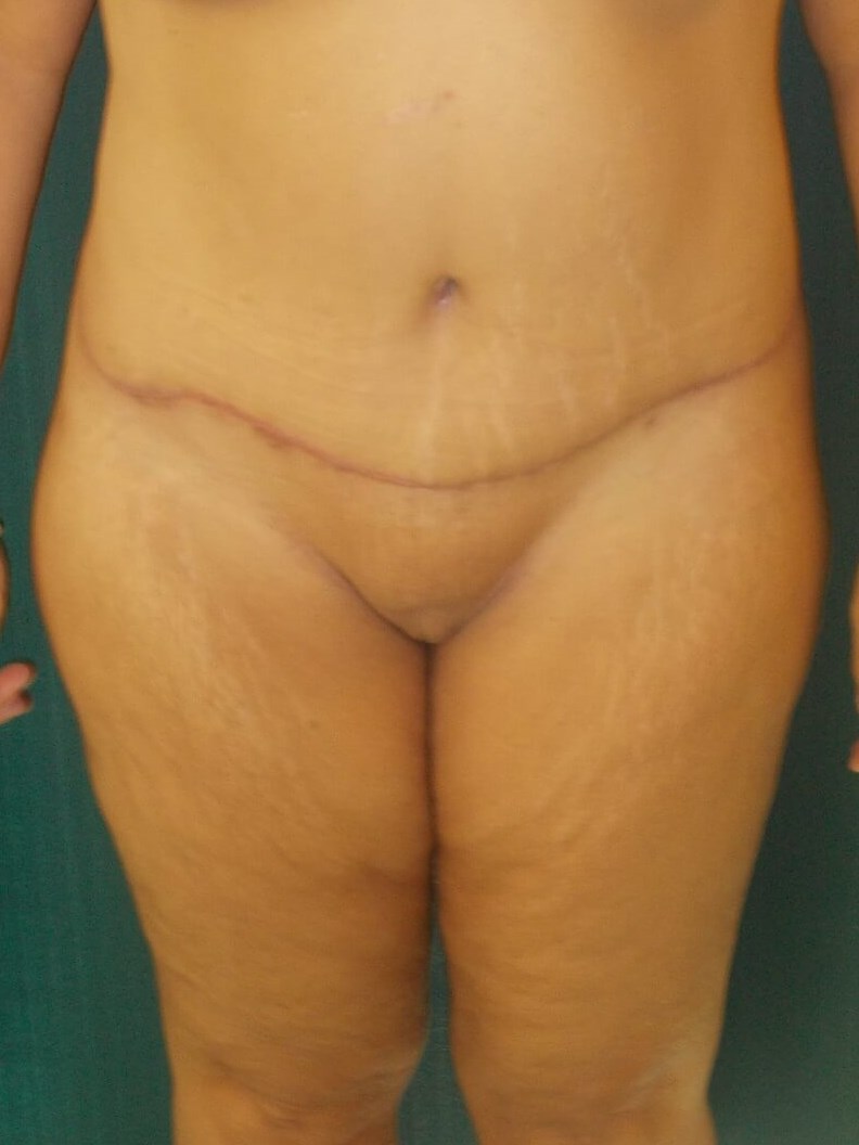 Front View After