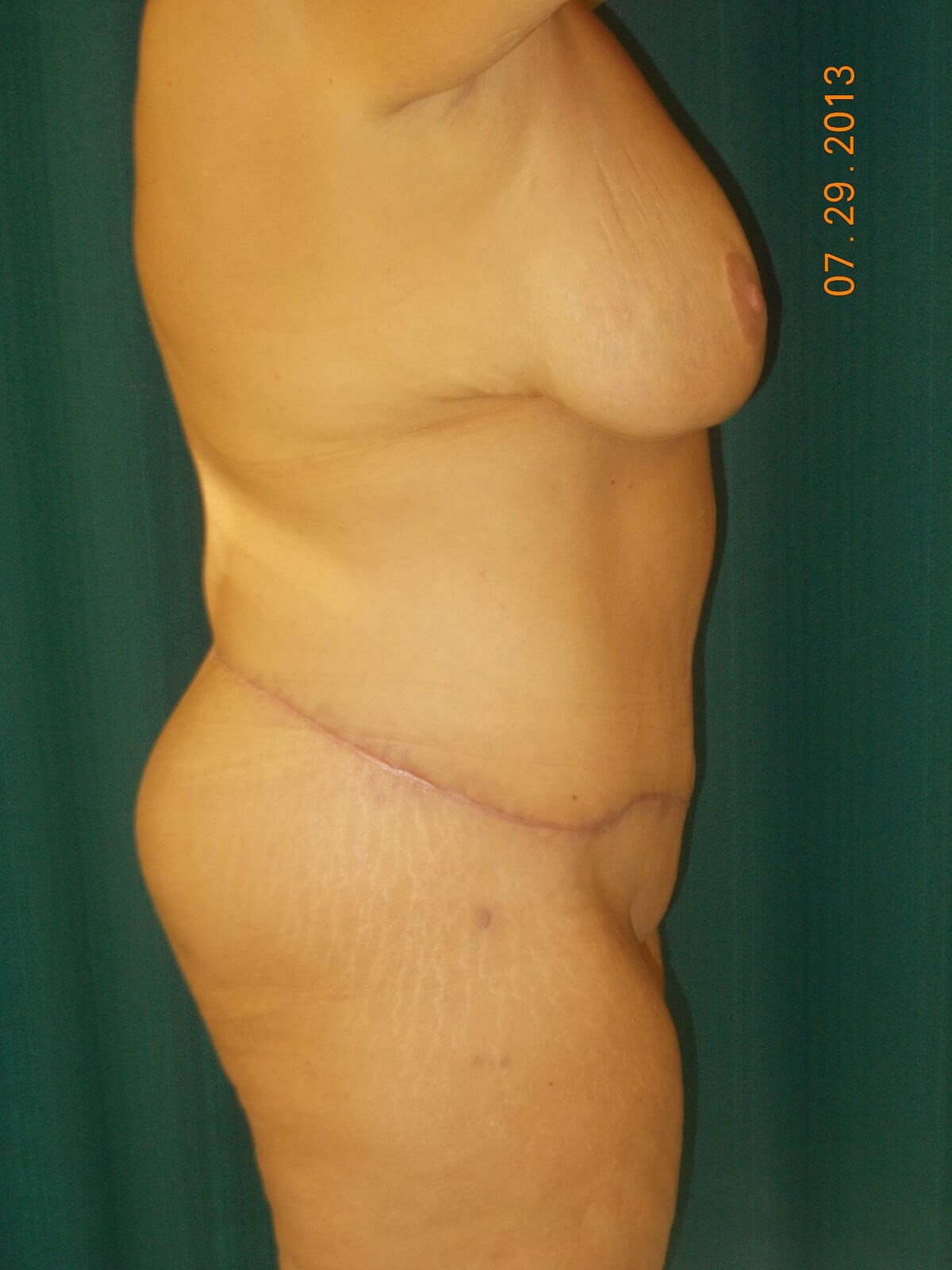 Side View After