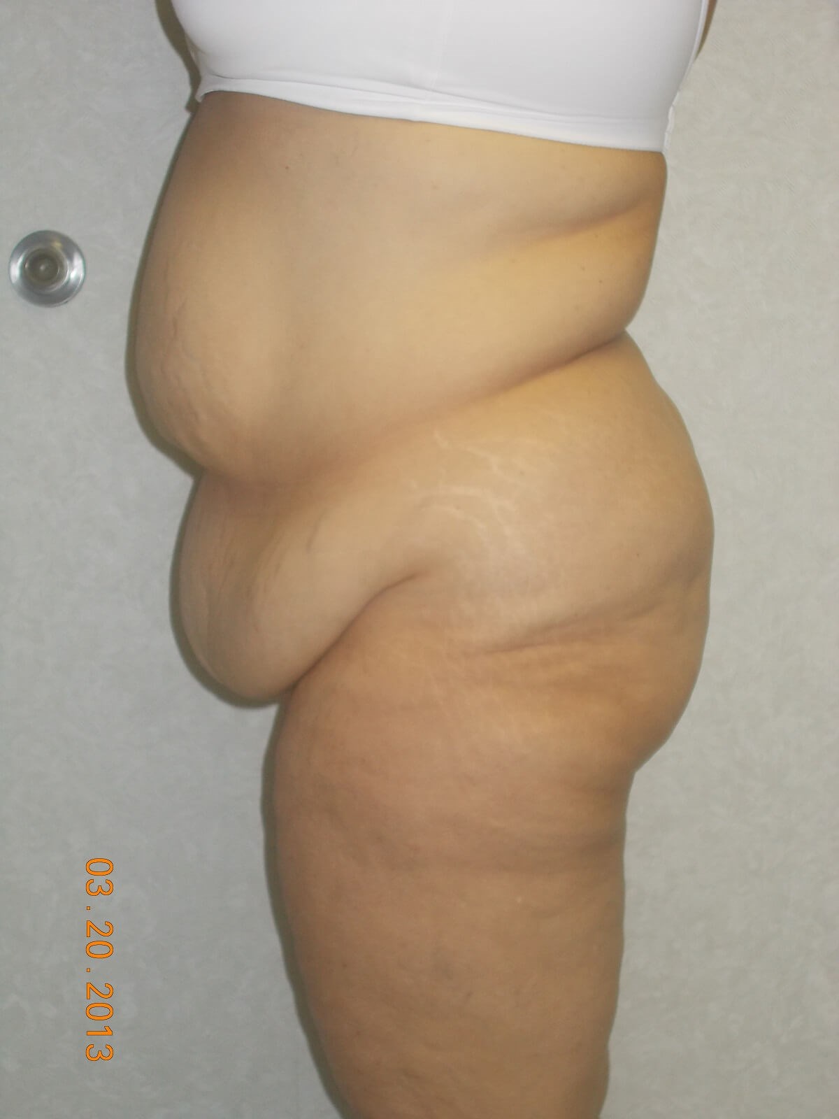 Side View Before