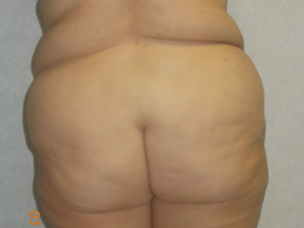 Back View Before