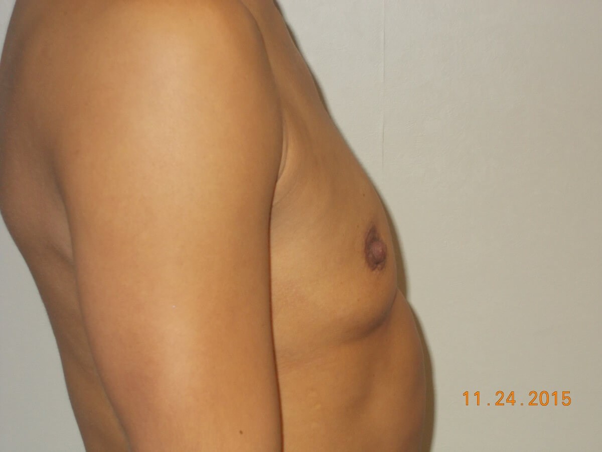 Side View Before