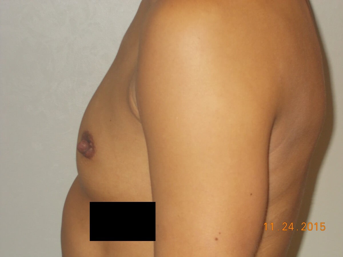 Side View Before