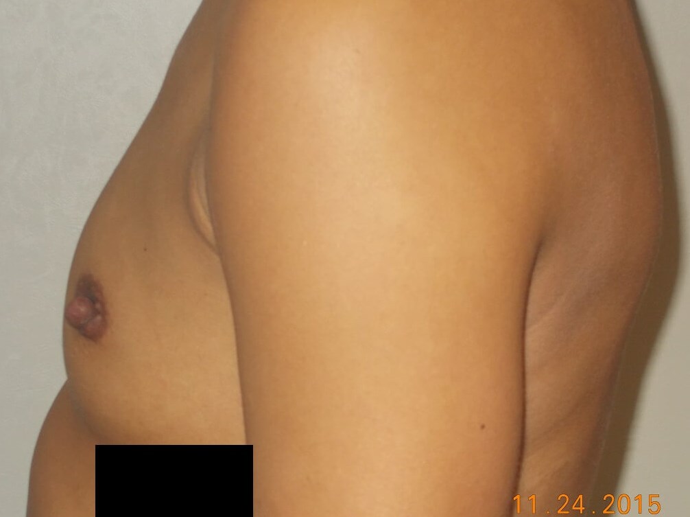 Side View Before