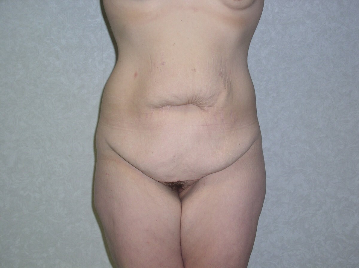 Front View Before