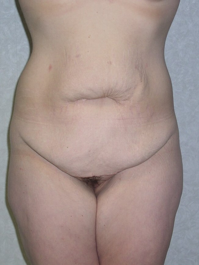 Front View Before