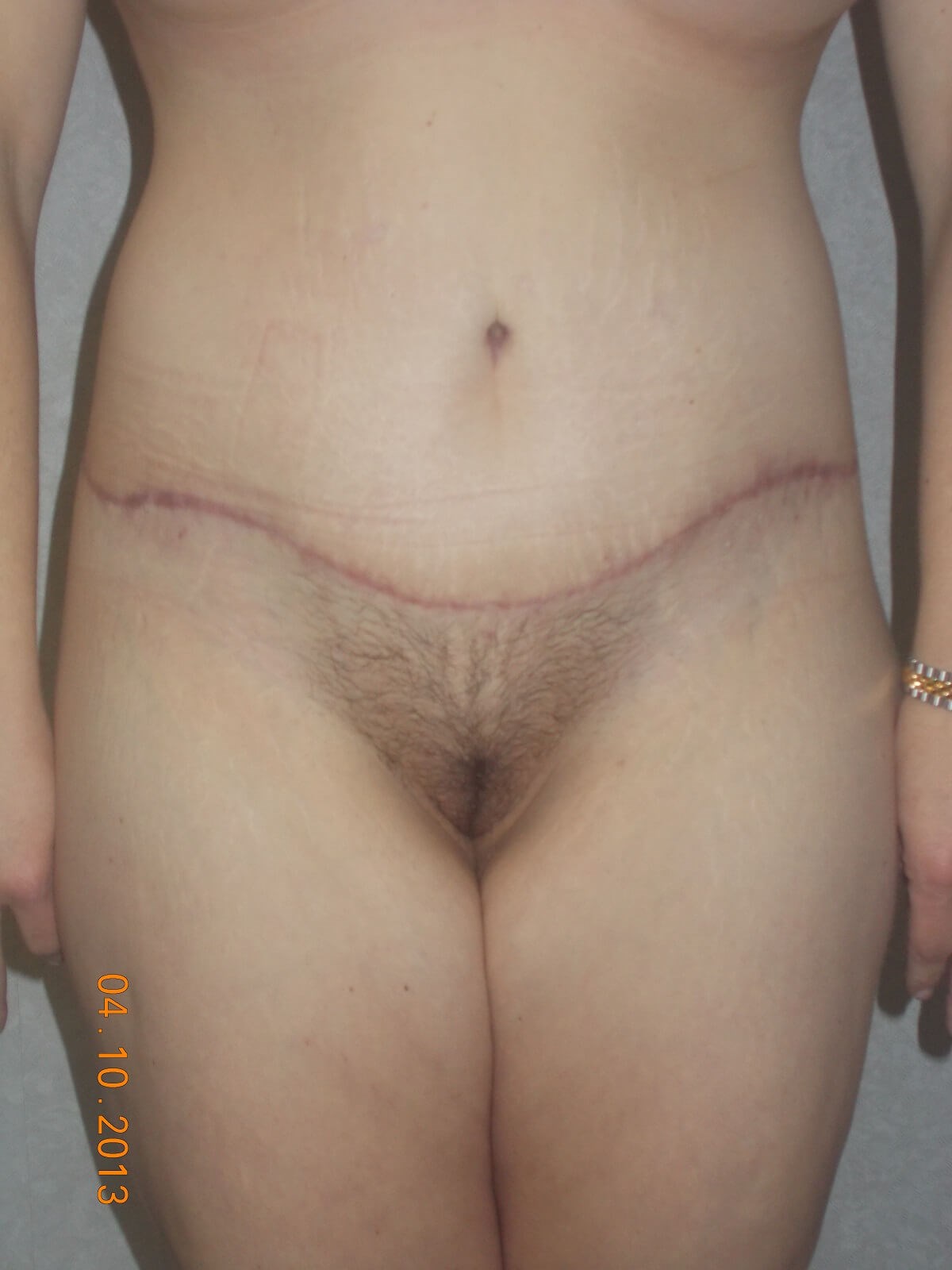Front View After