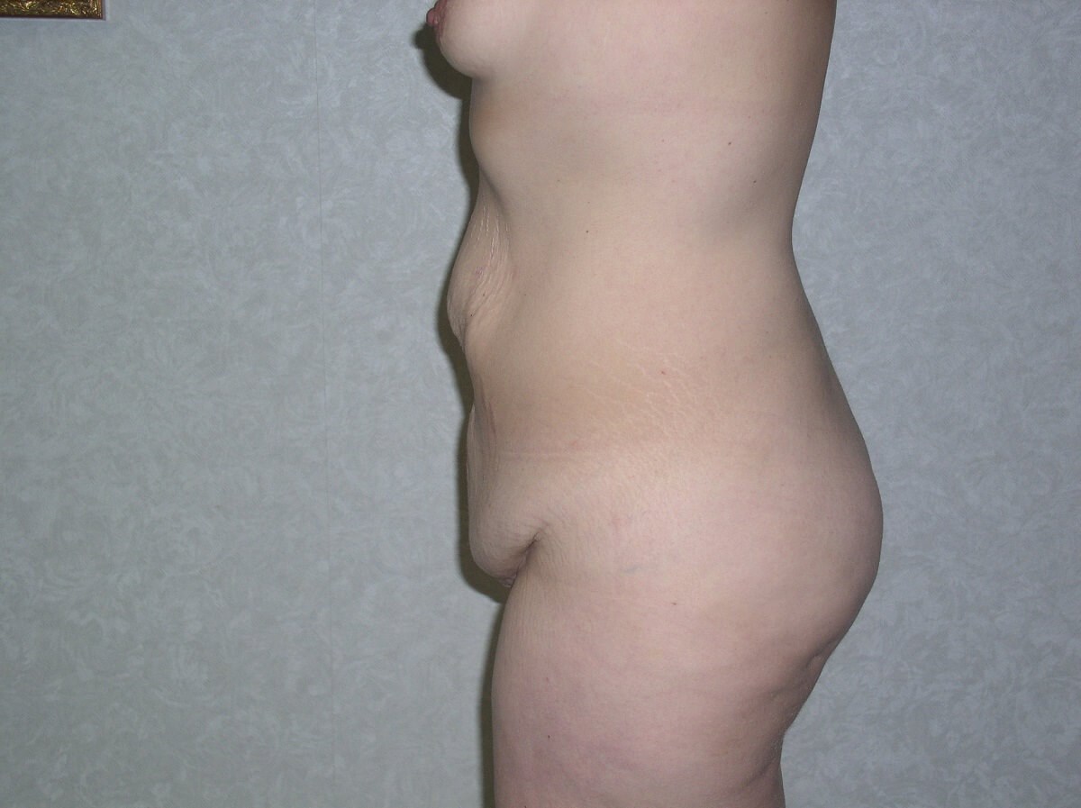 Side View Before