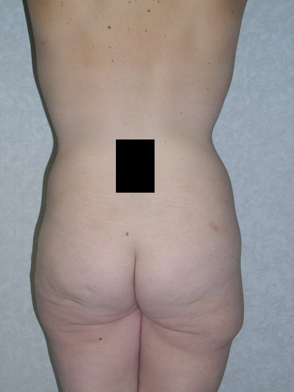 Back View Before