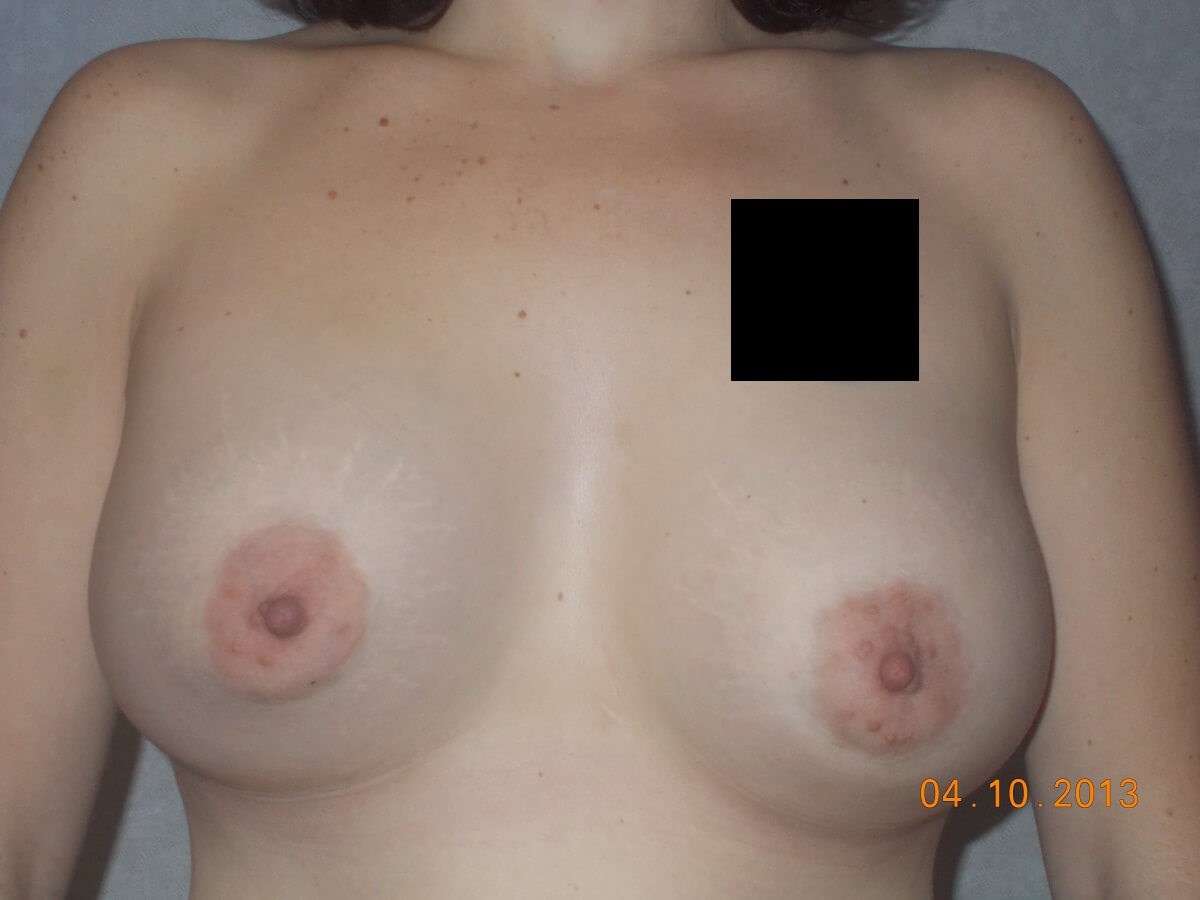 Front View After