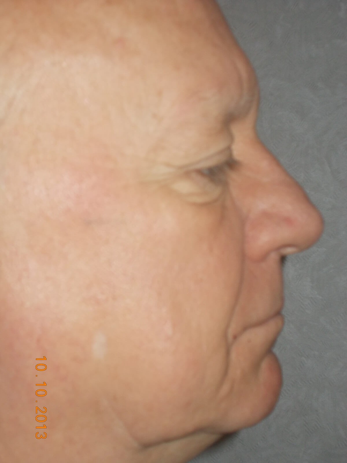 Side View Before