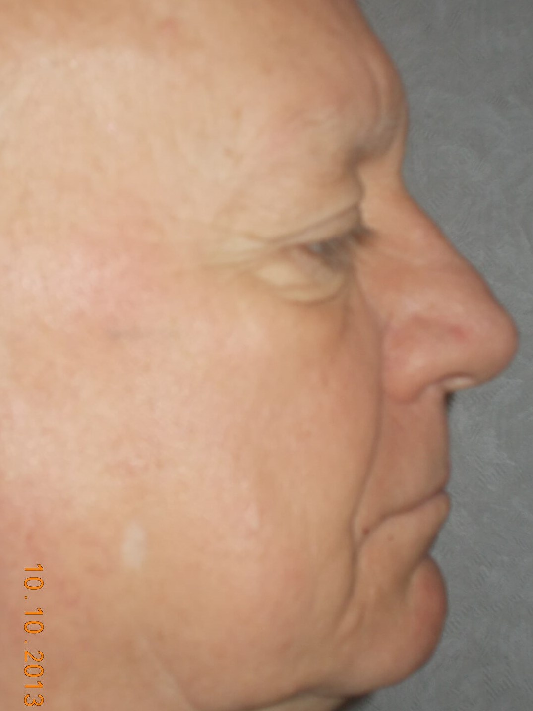 Side View Before