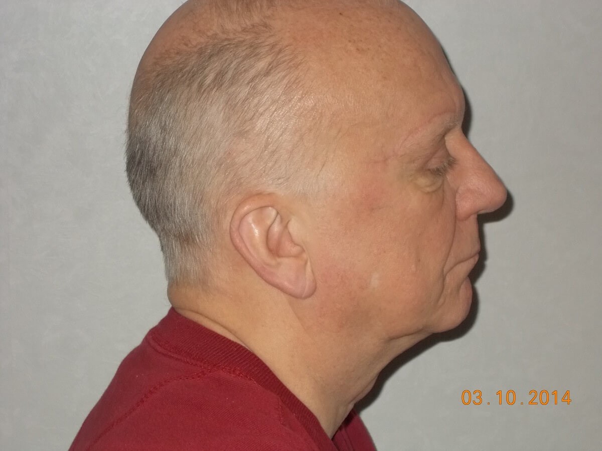 Side View After